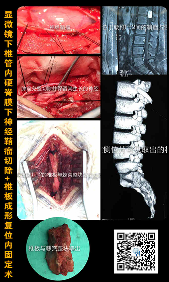 全椎板切除图解图片